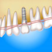 Perno endocanalare