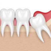 Pericoronite sintomi